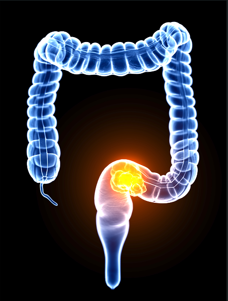 colorectal cancer
